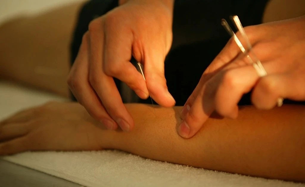 Fine acupuncture needles being placed along a forearm